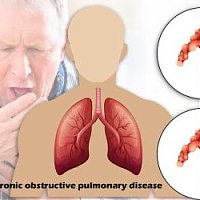 How to Manage Chronic obstructive pulmonary disease?