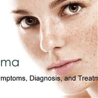 Melasma: Symptoms, Diagnosis, and Treatments