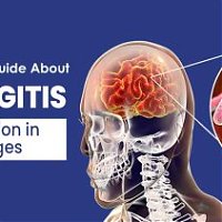Meningitis: Symptoms, Causes, Types and Treatment