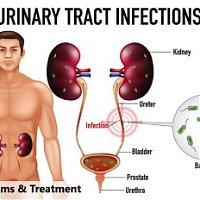 Urinary Tract Infections: Symptoms, Causes, and Treatment