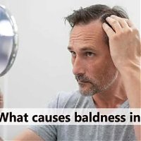 What causes baldness in men?