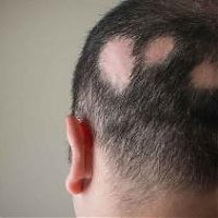 How does finasteride work in treating hair loss?