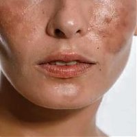 Hyperpigmentation and its Treatment