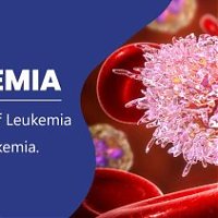 Leukemia: Here Is A Complete Guide For You