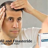 Minoxidil vs Finasteride: Do Both Really Work?