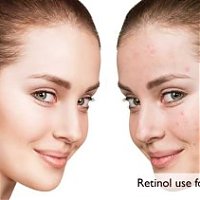 Few Important things about Retinol for Skin Care?