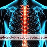 Complete Guide about Spinal Stroke